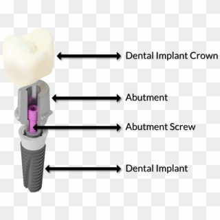 What Is The Difference Between A Dental Crown And A - Cutting Tool Clipart