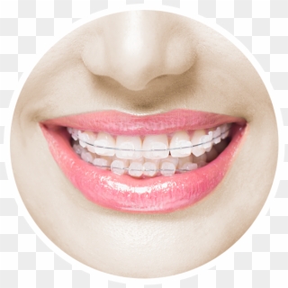 Svg Library Download Invisalign For Adults Teens More - Type Of Clear Brackets Clipart