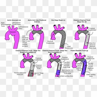 Graphical Representation Of Different Techniques For - Elephant Trunk Aortic Repair Clipart
