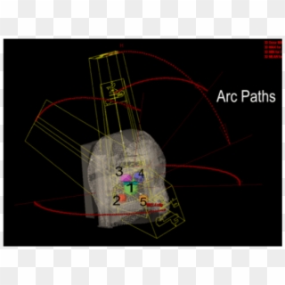 5-arc Rapidarc Radiosurgery Plan Treating 5 Targets - Circle Clipart