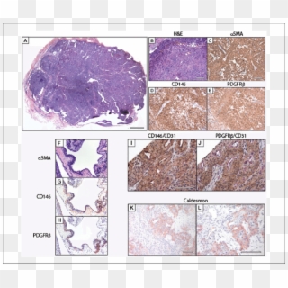 Pericytic Immunophenotype Of Glomus Tumor - Mineral Clipart