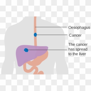 Esophagus Cancer Symptoms - Esophageal Cancer Clipart