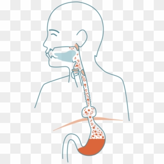 Hiatal Hernia Means That The Aperture In The Diaphragm - Illustration Clipart