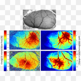 Laser Speckle Contrast Imaging And Multispectral Imaging - Laser Speckle Contrast Imaging Stroke Clipart