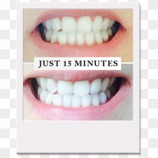 Professional Teeth Whitening System - Pearly White Review Clipart