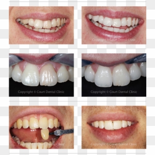 Tooth Beaconsfield Buckinghamshire Court Dental Clinic - Lip Gloss Clipart
