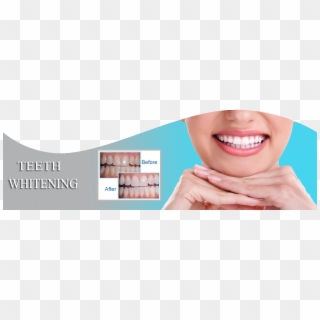 Call Us - Braces Fixed Canted Smile Clipart