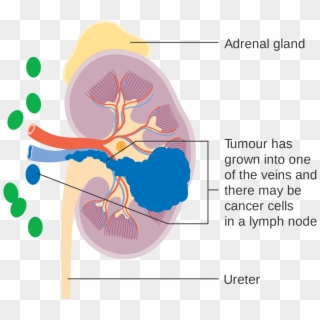 Kidney Cancer Surgery - Kidney Cancer Clipart
