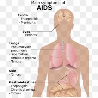 Hiv Aids Png 2-2 Png Image - Symptoms Of Aids Clipart