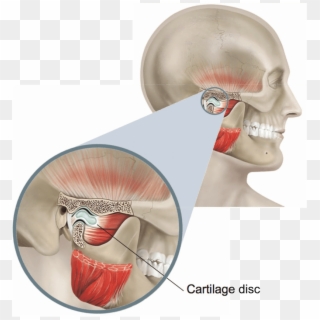 Illustration Showing The Temporomandibular Joint - Tmj Surgery Clipart