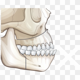 Correction With Two-jaw Surgery - X Music Festival 2017 Cardiff Clipart