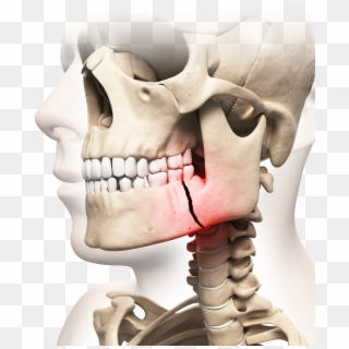 Illustration Of Skull With Broken Jaw Highlighted In - Oral Maxillofacial Surgery Trauma Clipart