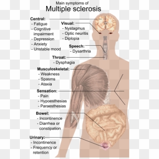 Symptoms Of Multiple Sclerosis - Multiple Sclerosis Body Clipart