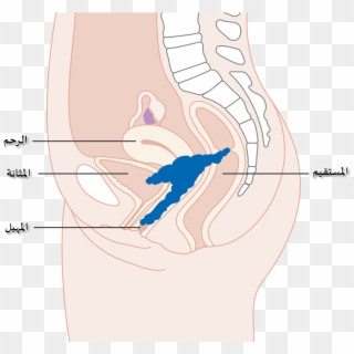 Diagram Showing Stage 4a Cervical Cancer Cruk 236-ar - Illustration Clipart