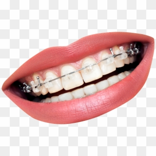 Transparent Mouth With Braces Clipart
