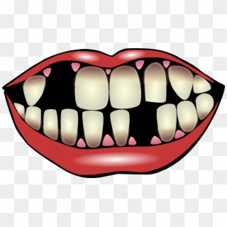 What Leads To Missing Teeth - Missing Teeth Clipart - Png Download