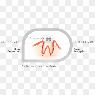 How Teeth Move - Illustration Clipart