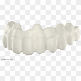 Implant Retained Denture - Bone Clipart