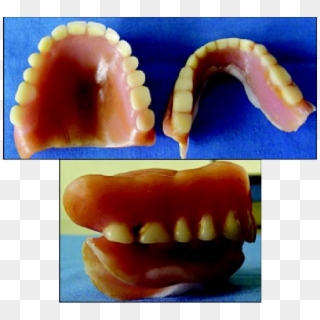 Existing Dentures Of The Patient - Denture Teeth Wear Clipart