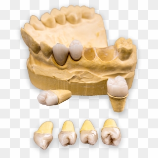 When Your Gums Are Restored To A Healthy Condition - Sculpture Clipart