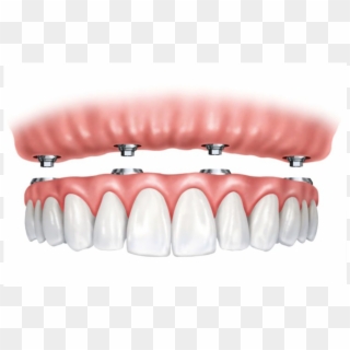 Implant Supported Overdentures - Implant Replacement All Teeth Clipart