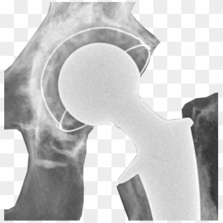 Postoperative Radiograph Of Hip Prosthesis - Hip Replacement Clipart