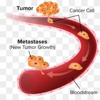 Metastasis - Cancer Cell Metastasis Clipart