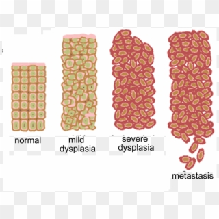 Progressive Increases In Cell Division And Abnormal - Hypertrophy Hyperplasia Metaplasia And Dysplasia Clipart