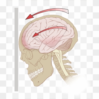 Concussion Injury Clipart