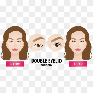 Types Of Double Eyelid Surgery - Girl Clipart