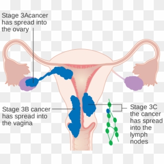In Stage Iii, The Cancer Has Spread To The Lower Third - 子宮 內 膜 癌 放療 Clipart
