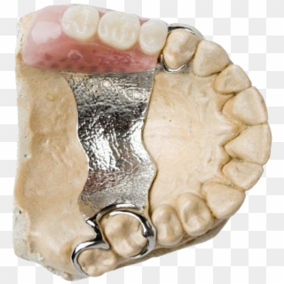 Complete & Partial Dentures, Dentures - Dental Prosthesis Clipart