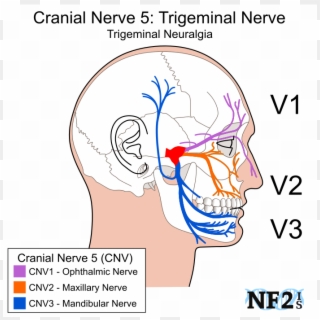 Cranial Nerve 5, Subparts, 3 Branches, Branches, Filiment, - Neurofibromatosis Type Ii Clipart