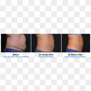 3 Picture Before And Afters For Coolsculpting Orlando-2 - Photo Caption Clipart