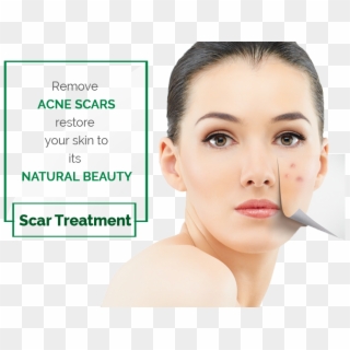 Laser Acne Scars Removal Treatment - Santa Maria Clipart