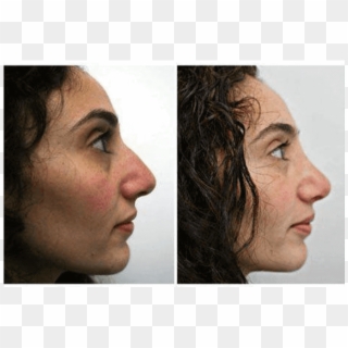 Before And After Rhinoplasty - Graphics Software Clipart