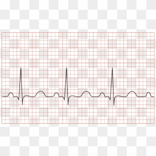 Tachycardia Ecg Paper - Amsler Grid Scotoma Clipart