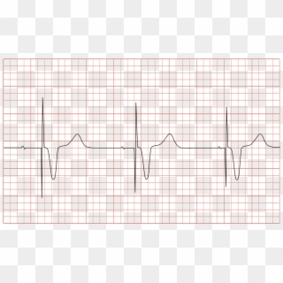 Ecg Pacemaker Syndrome - Ecg Pacemaker Clipart
