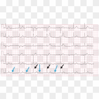 Handwriting , Png Download - Right Ventricular Conduction Delay Ecg Clipart