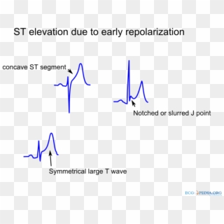 St Elevation Due To Repolarization - Concave Upward St Elevation Clipart