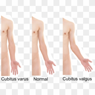 Cubitus Varus And Cubitus Valgus - Valgus Deformity Hand Clipart
