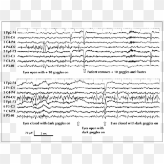 Continuous Right Occipital Spiking When Eyes Are Open - Fixation Off Sensitivity In Eeg Clipart