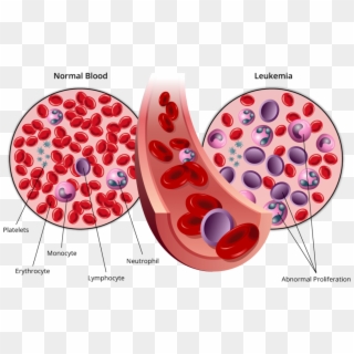 Stages Of Leukemia - Cancer Blood Clipart