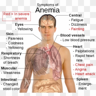 Symptoms Of Anaemia - Symptoms Of Anemia Clipart