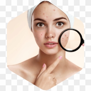 Types Of Acne Scarring - Acne Treatment Png Clipart