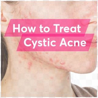 What Is The Best Treatment For Cystic Acne - Tattoo Clipart
