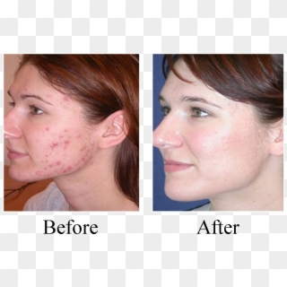 Hopkins Chiropractic Care For Acne & Other Skin Conditions - Dermaplaning Hair Before And After Clipart