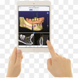 From Prosthetic To Surgical Planning - 3diemme Clipart