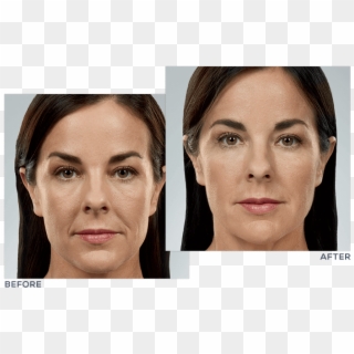Juvéderm® Facial Filler Treatment - Juvederm Face Clipart