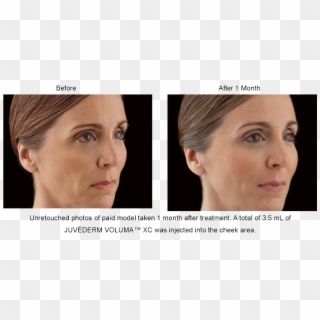 Juvederm Voluma Xc Before And After Picture - Cheek Augmentation With Fillers Before And After Clipart